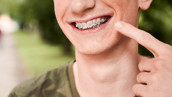 Продажи виниров и пломб на маркетплейсах увеличились на 63% в I квартале